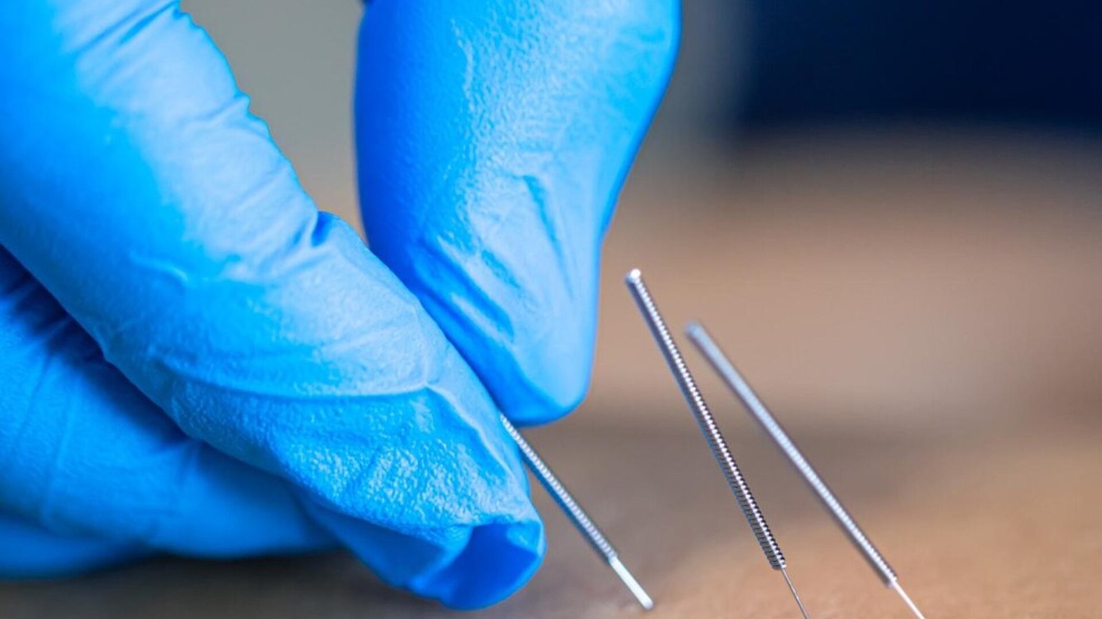 Close-up de Acupuntura no Espaço Fisiospa com foco na aplicação da técnica