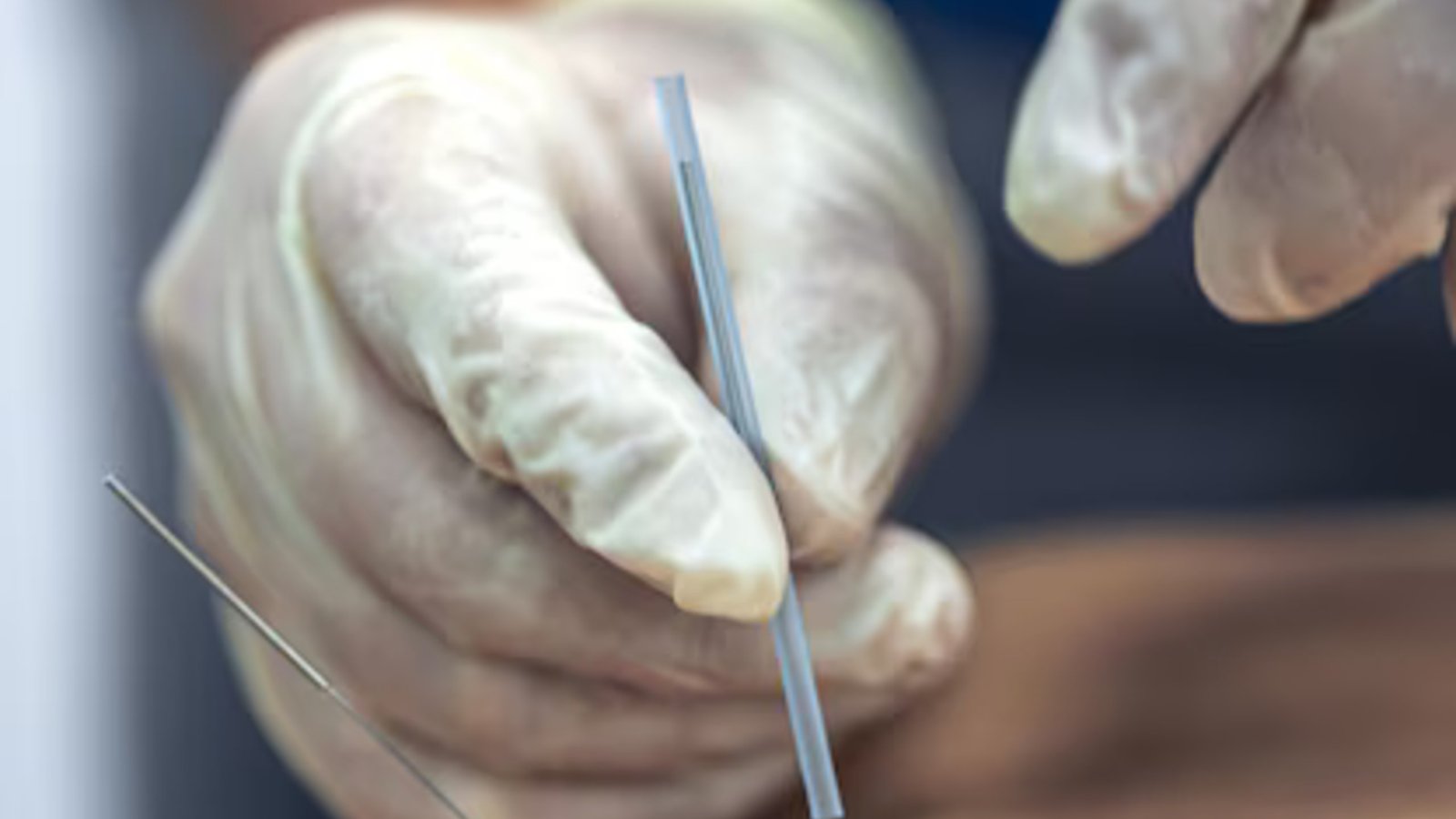 Acupuntura no Espaço Fisiospa com foco direto na técnica, sem mostrar rosto